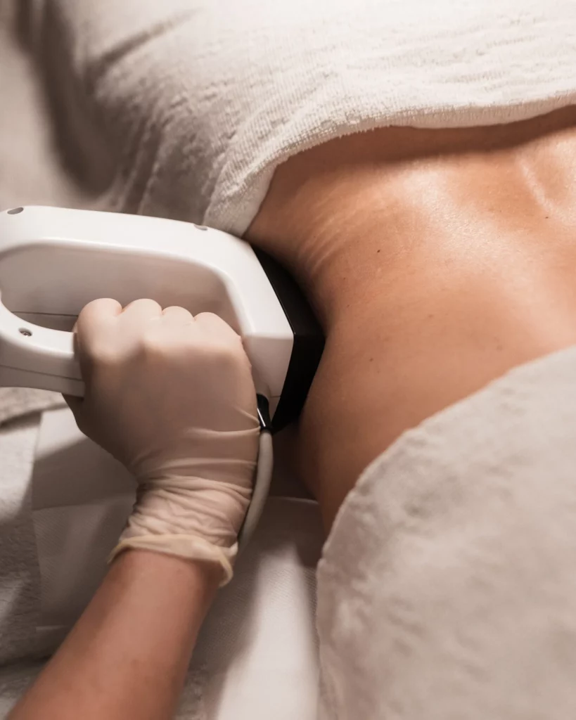 Radiofrequenza sul fianco: il manipolo lavora in una zona precisa del corpo
